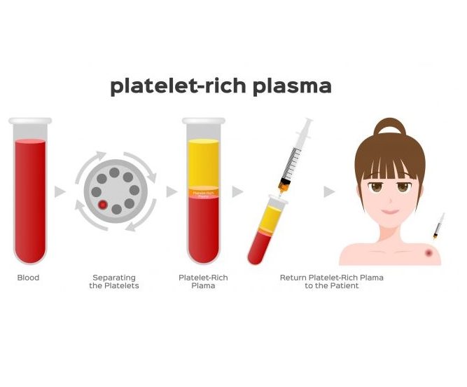 PRP TPI
