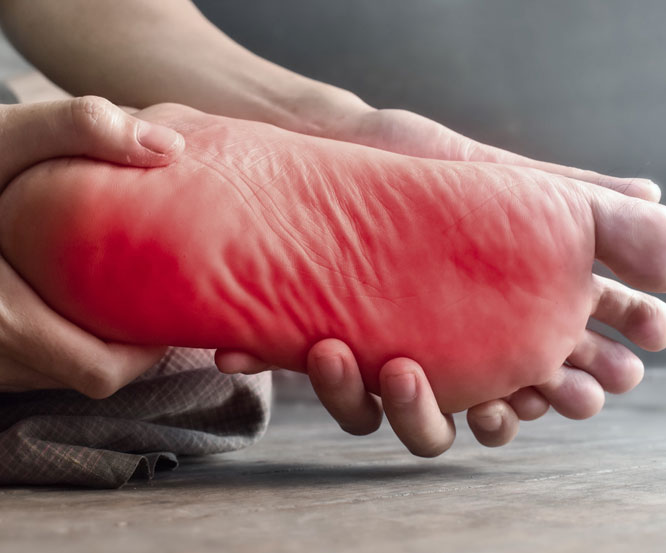 What Is Treatment of Plantar Fasciitis with Platelet Rich Plasma PRP